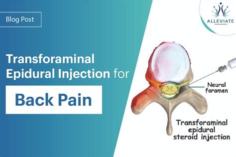 Injection Back Pain 的图像结果