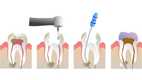 What is Root Canal Treatment and What is the Procedure? - Smile Delivery Online