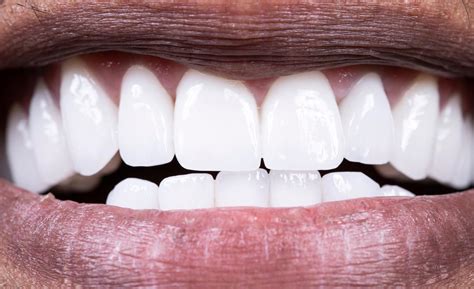 Calculus Bridge: What It Is, How to Prevent It and More