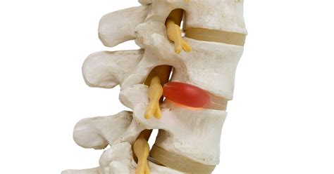Chiropractic Treats Herniated Disc Pain | Buffalo, NY Chiropractor ...