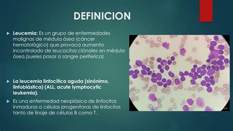 Imágenes De Células De Leucemia Linfoblástica Aguda Leucemia