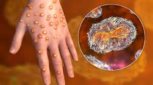 Monkeypox hits India: First case of fast-spreading Mpox clade 1 ...