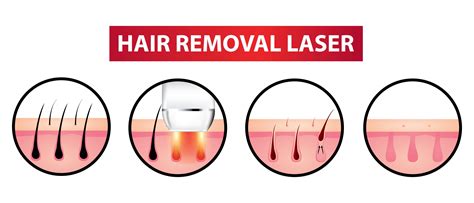 Does Laser Hair Removal Work Better Than Electrolysis at Gemma Dalton blog
