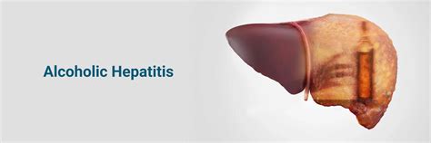 Alcoholic Hepatitis: Protect Your Liver Health Now