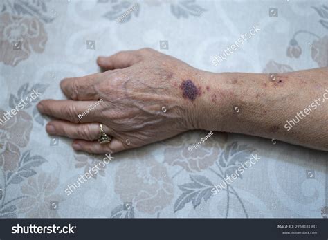 Bruises On Hand Elderly Woman Wrinkled Stock Photo 2258181981 | Shutterstock