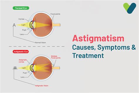 Astigmatism: Ultimate Guide to Causes, Symptoms & Treatment - causes of astigmatism