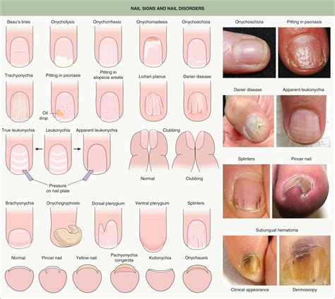Nail Disorders – Clinical Tree