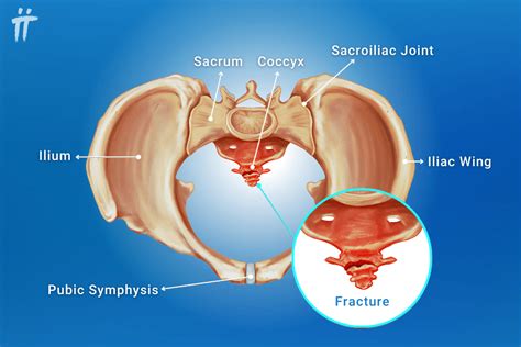Tailbone Pain (Coccygodynia): Coccyx Pain Symptoms, Treatment Turan&Turan