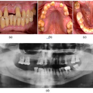 Image result for Tooth Extraction Side Profile