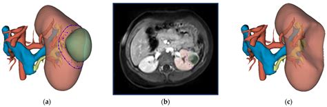 Virtual Resection: A New Tool for Preparing for Nephron-Sparing Surgery ...