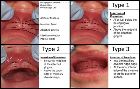 Labial Frenulum