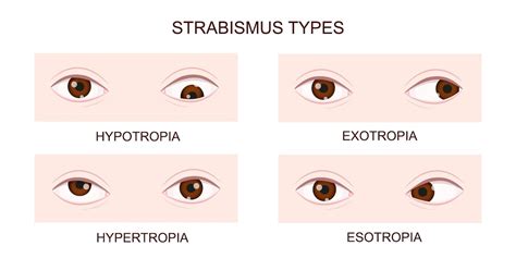 Tipos de estrabismo Hipotropia hipertropia exotropia esotropia Olhos ...