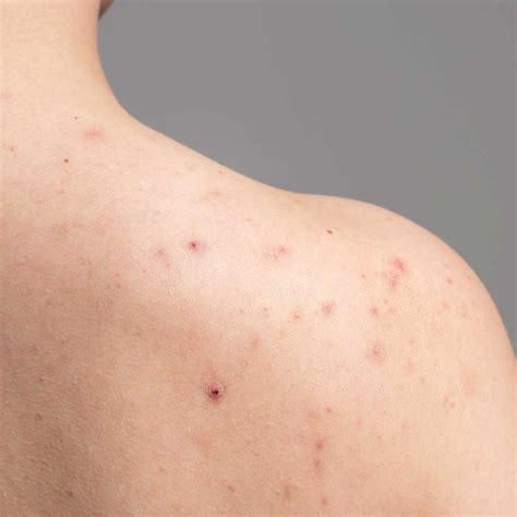 What Is Bacne and How to Get Rid of It? – mCaffeine