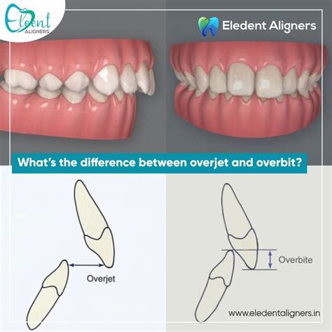 Overbite y overjet | Escuela de higiene dental, Anestesia en odontologia, Odontología