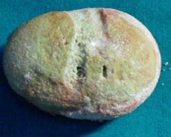 Kidney Stone Treatment Chennai | Anandan's Urology Clinic