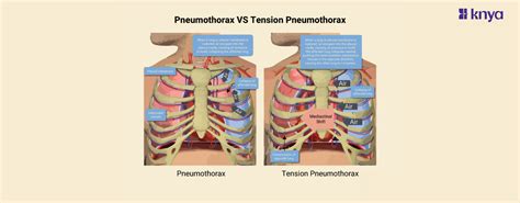 Pneumothorax vs Tension Pneumothorax | Collapsed Lung vs. Emergency – Knya