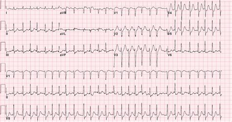 Image result for AFib Detection Algorithm