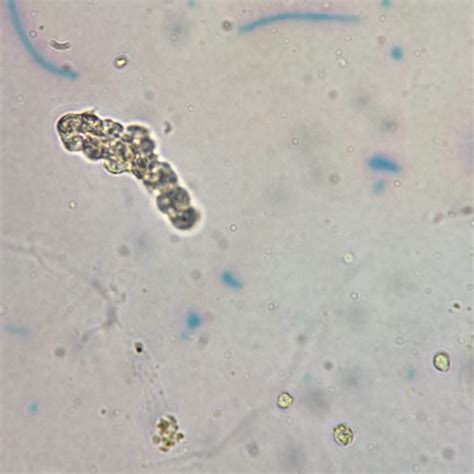 White Blood Cell Casts: Identification & Significance - MedLabBuddy