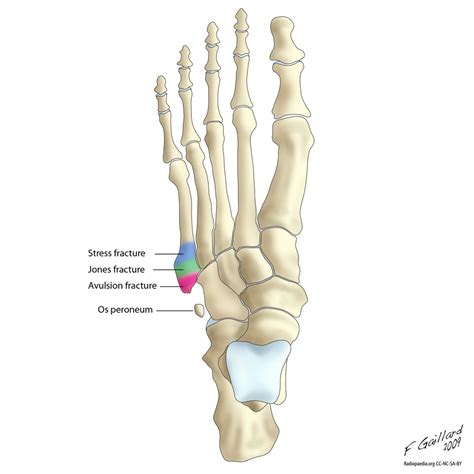 Fractures of the proximal 5th metatarsal | Radiology Case | Radiopaedia ...
