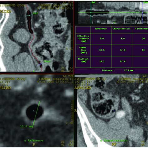 Image result for Normal Appendix Diameter