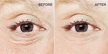 Neutrogena Rapid Wrinkle Repair Night Moisturizer For Face With Retinol ...