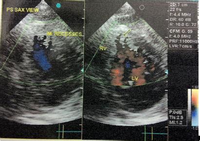 Biventricular non-compaction (spongiform) cardiomyopathy | Pediatric ...