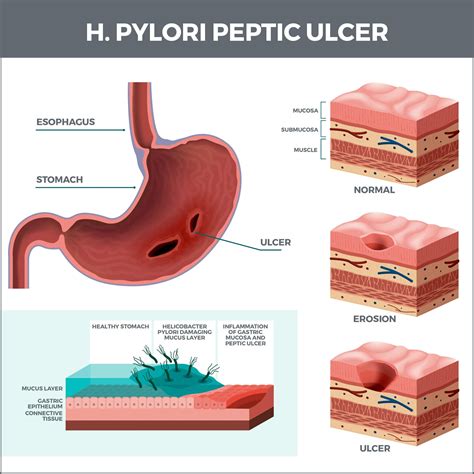 H. pylori Peptic Ulcer | Gastro MD