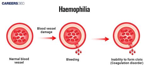 Hemophilia: Overview, Meaning, Causes, types, symptoms, treatment