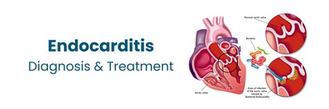 Best Endocarditis Diagnosis and Treatment in Begumpet