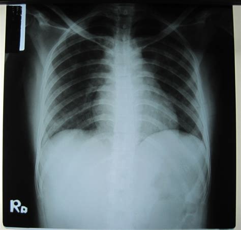 Fig. 2: Chest radiograph (Chest X-Ray)