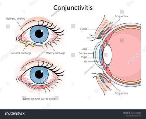 288 Eyelids Conjunctivitis Stock Vectors and Vector Art | Shutterstock