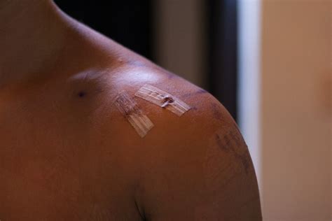 Image result for Shoulder Labral Tear Surgery