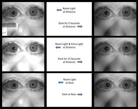 Atlas Entry - Apraclonidine Drop Testing for Horner Syndrome