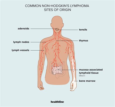 How Common Is Non Hodgkin's Lymphoma