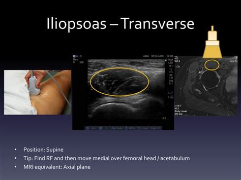 How to Perform Hip Ultrasound 的图像结果