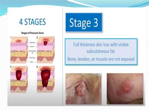 Definitions Pressure ulcers: Nursing home providers were asked the ...