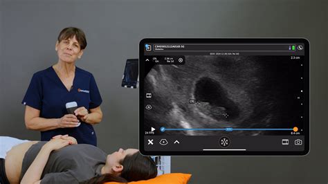 Crown Rump Length (CRL) Measurement | Clarius