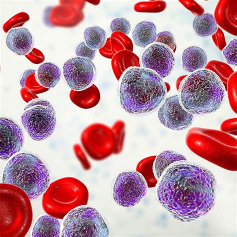 Revumenib ist neue Therapieoption bei KMT2Ar akuter Leukämie ...