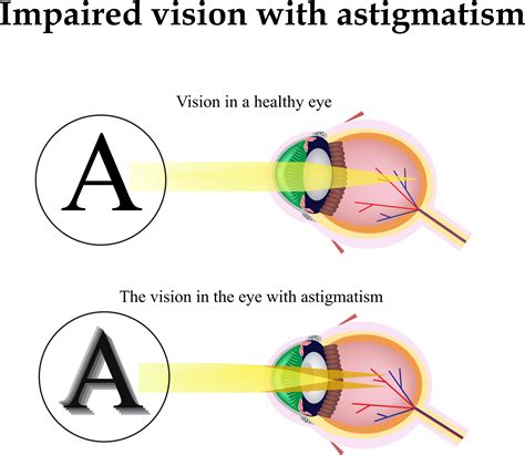 Cataract Surgery Astigmatism at Tanner Troy blog