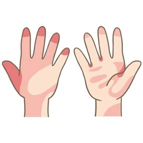 手の洗い残しがわかるイラスト🎨【フリー素材】｜看護roo![カンゴルー]