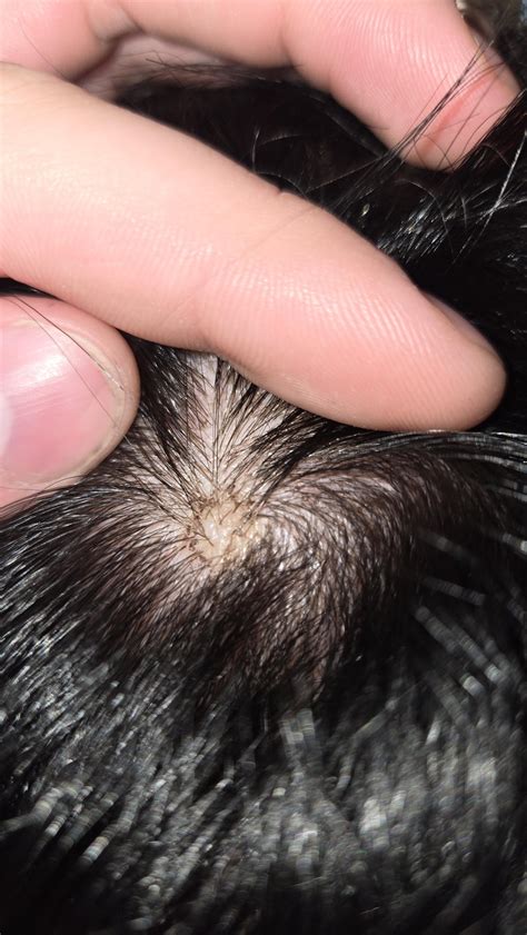 Scalp bump : r/DermatologyQuestions