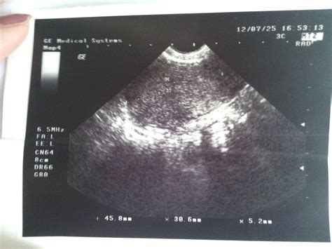 怀孕第9周双胞胎B超图 - 每日头条