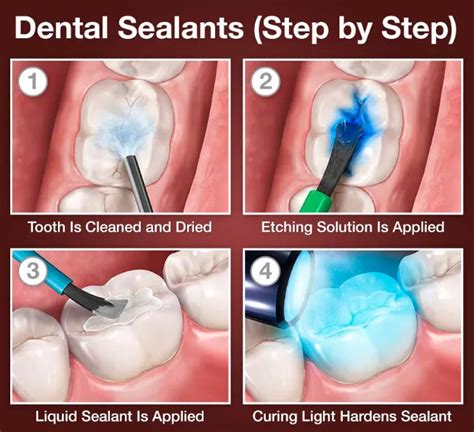 Buy Prevest Denpro PF Seal Pit and Fissure Sealant (20012) – Oralkart