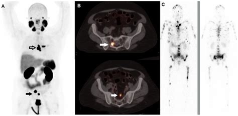 The Role of PET and SPECT Imaging in Prostate Cancer Targeted Alpha Therapy: When and How?