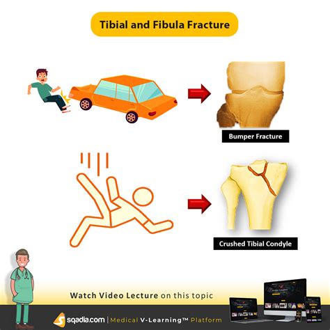 sqadia.com — Tibial and fibula fracture occurs below the knee...