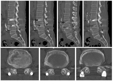 Recurrent Spinal Canal Stenosis after Decompression and Fusion Surgery ...