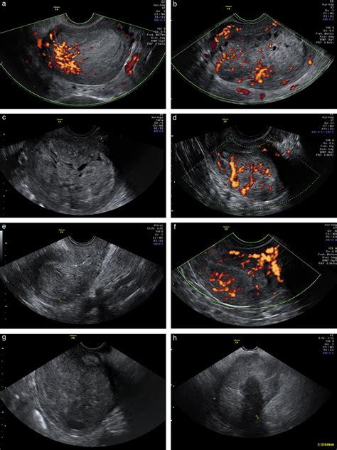Ultrasound characteristics of endometrial cancer as defined by International Endometrial Tumor ...