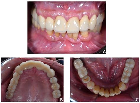 Prosthetically Guided Orthodontics (PGO): A Personalized Clinical ...