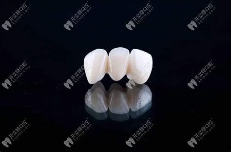 全瓷牙套多少钱价格表2023(一颗牙冠费用有1200/1500/1800/3000元) - 口腔保健 - 开立特口腔