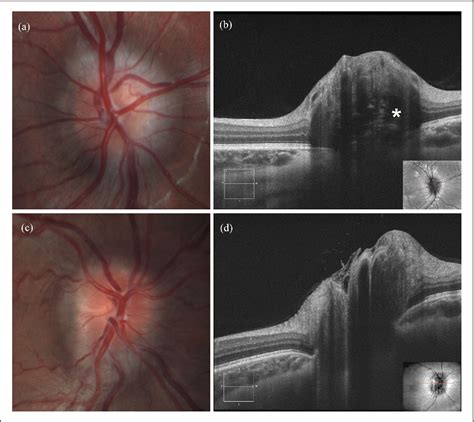 Diagnosis of optic nerve head drusen using enhanced depth imaging optical coherence tomography ...